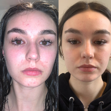 LED Light Therapy Mask LITE