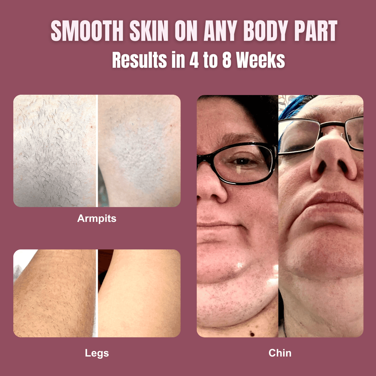 IPL Hair Removal PRO