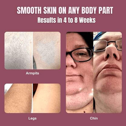 IPL Hair Removal PRO