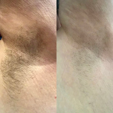 IPL Hair Removal PRO
