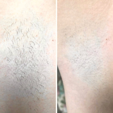 IPL Hair Removal PRO MAX